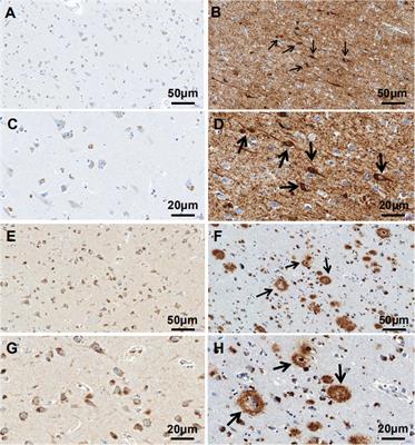 Increased MANF Expression in the Inferior Temporal Gyrus in Patients With Alzheimer Disease